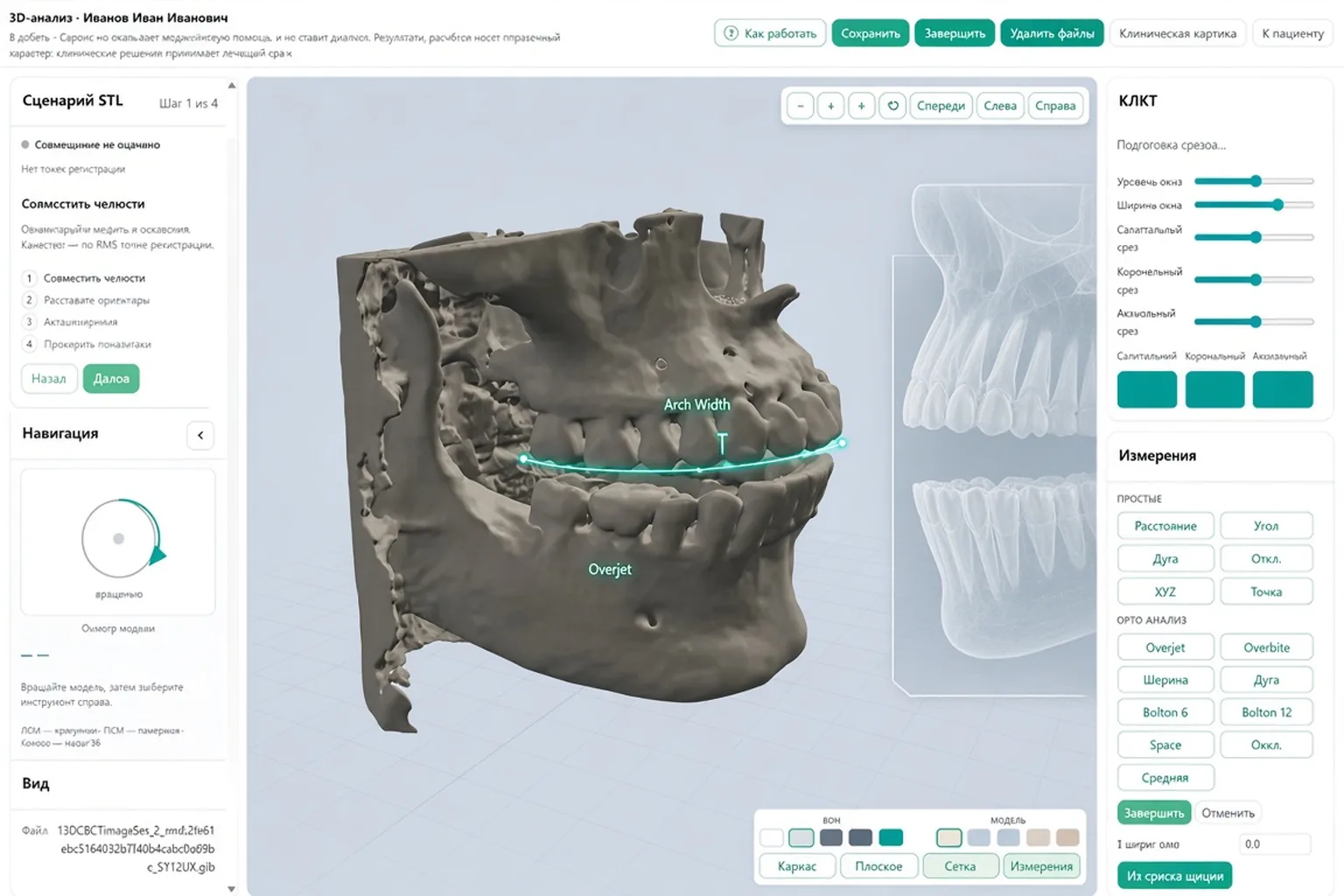 Modelo tridimensional de maxilares con mediciones en el módulo CephCalc