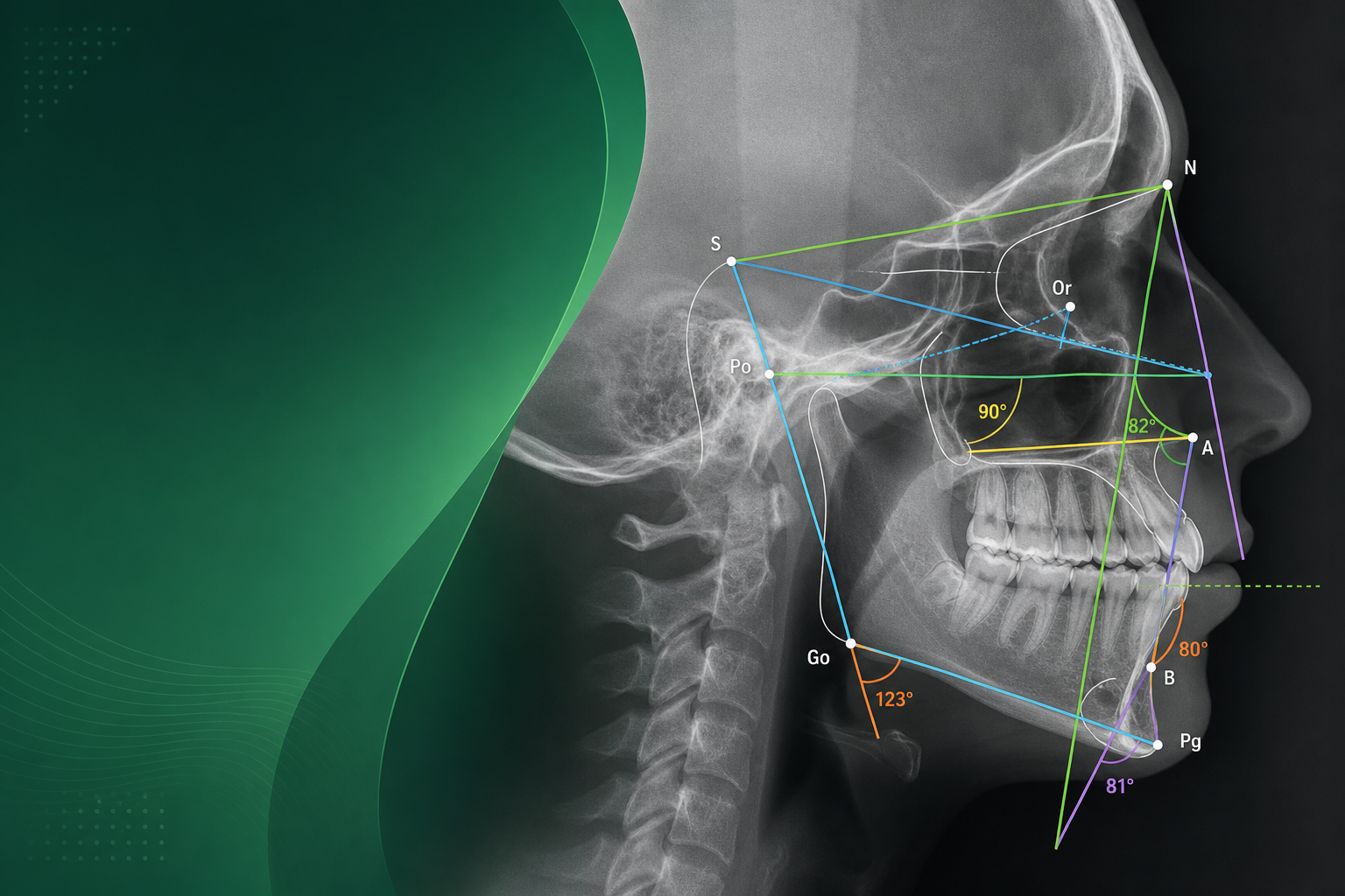 Radiografía cefálica lateral con líneas y ángulos cefalométricos